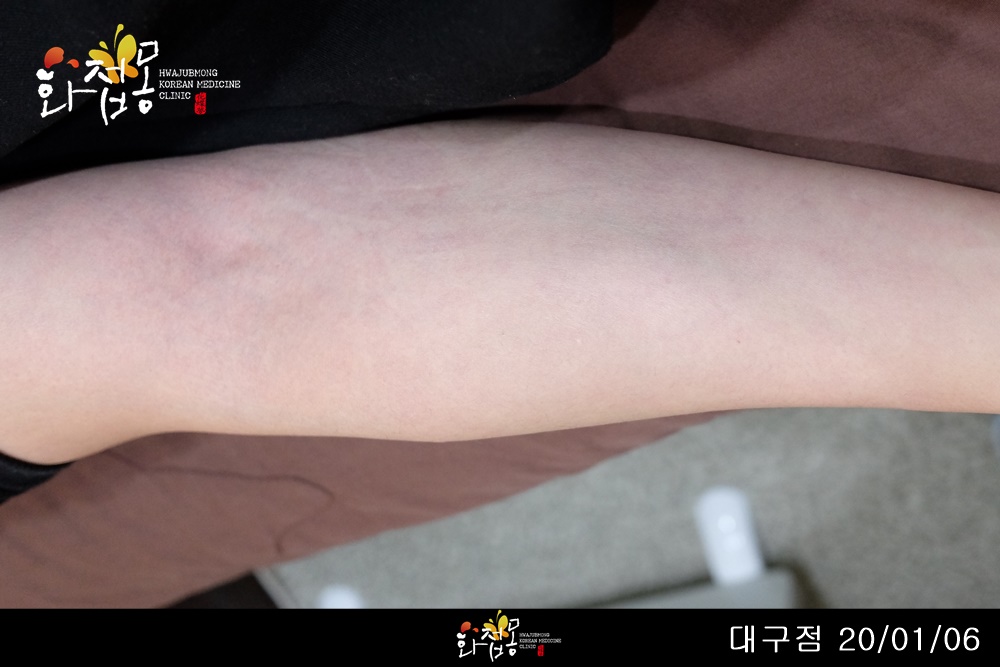 전후사진
