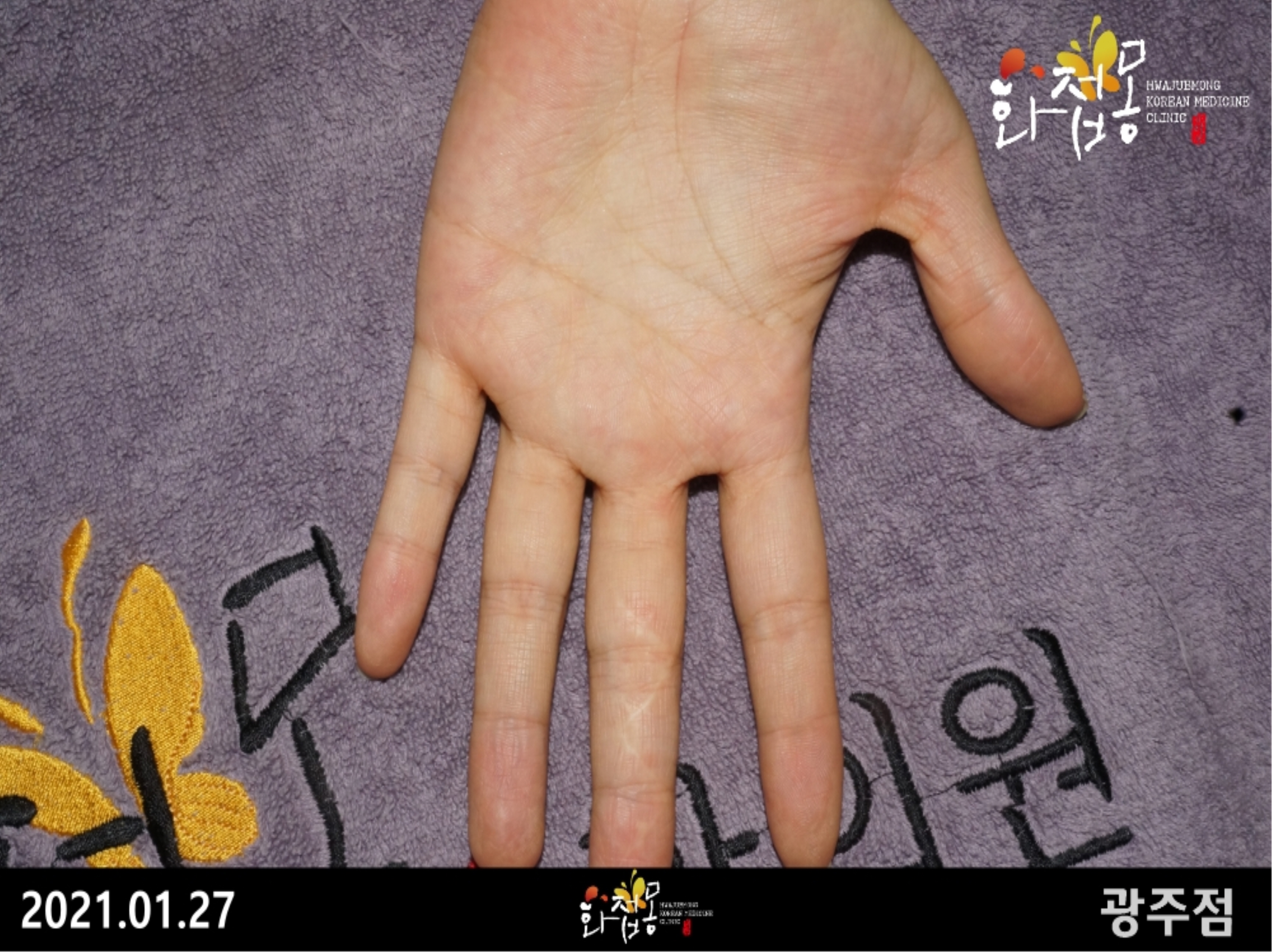 전후사진