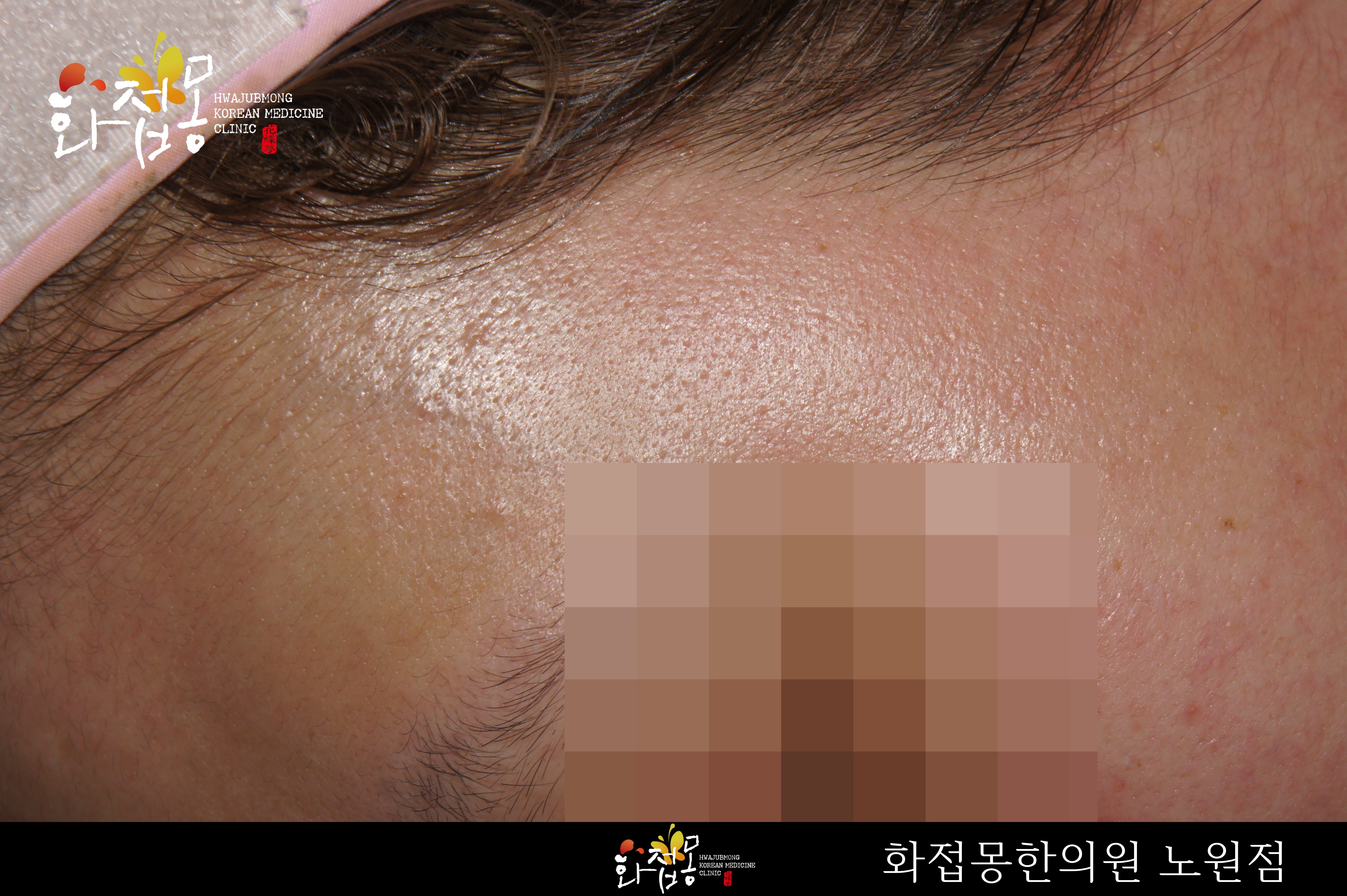 전후사진