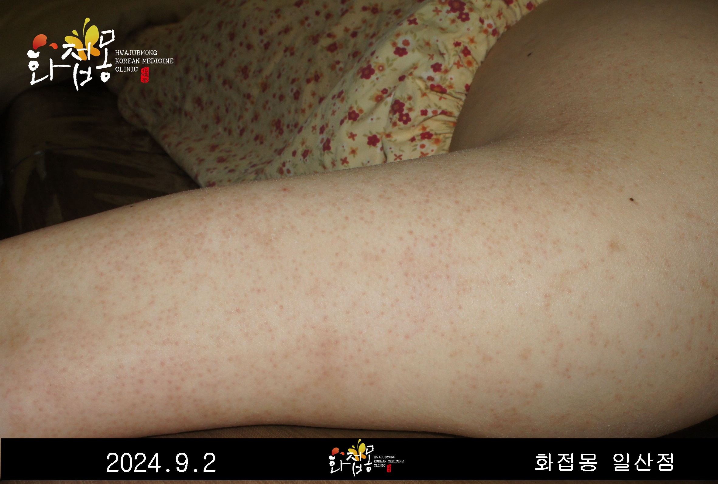 전후사진