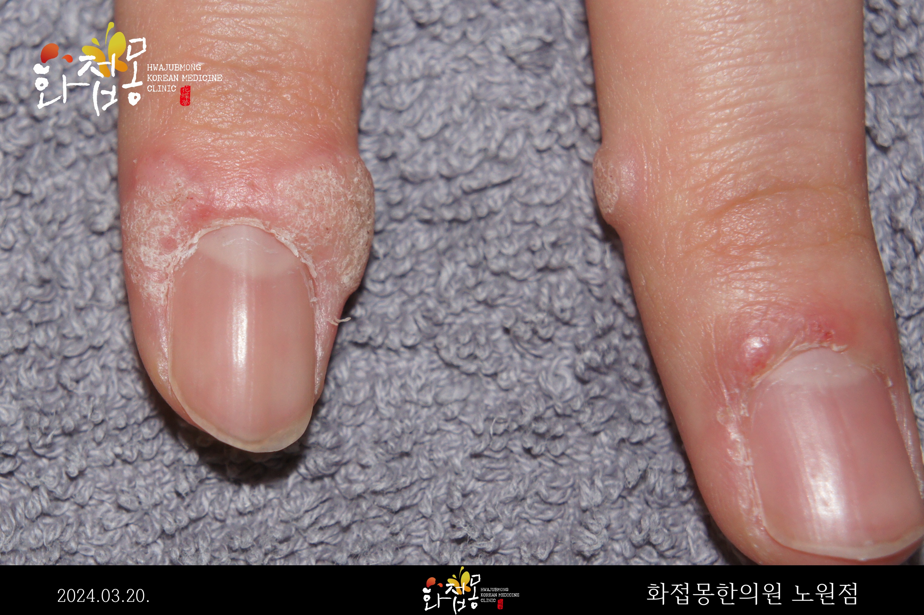 전후사진