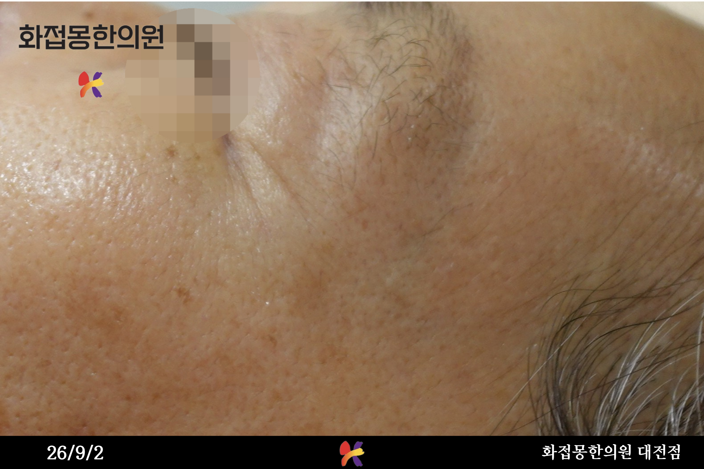 전후사진