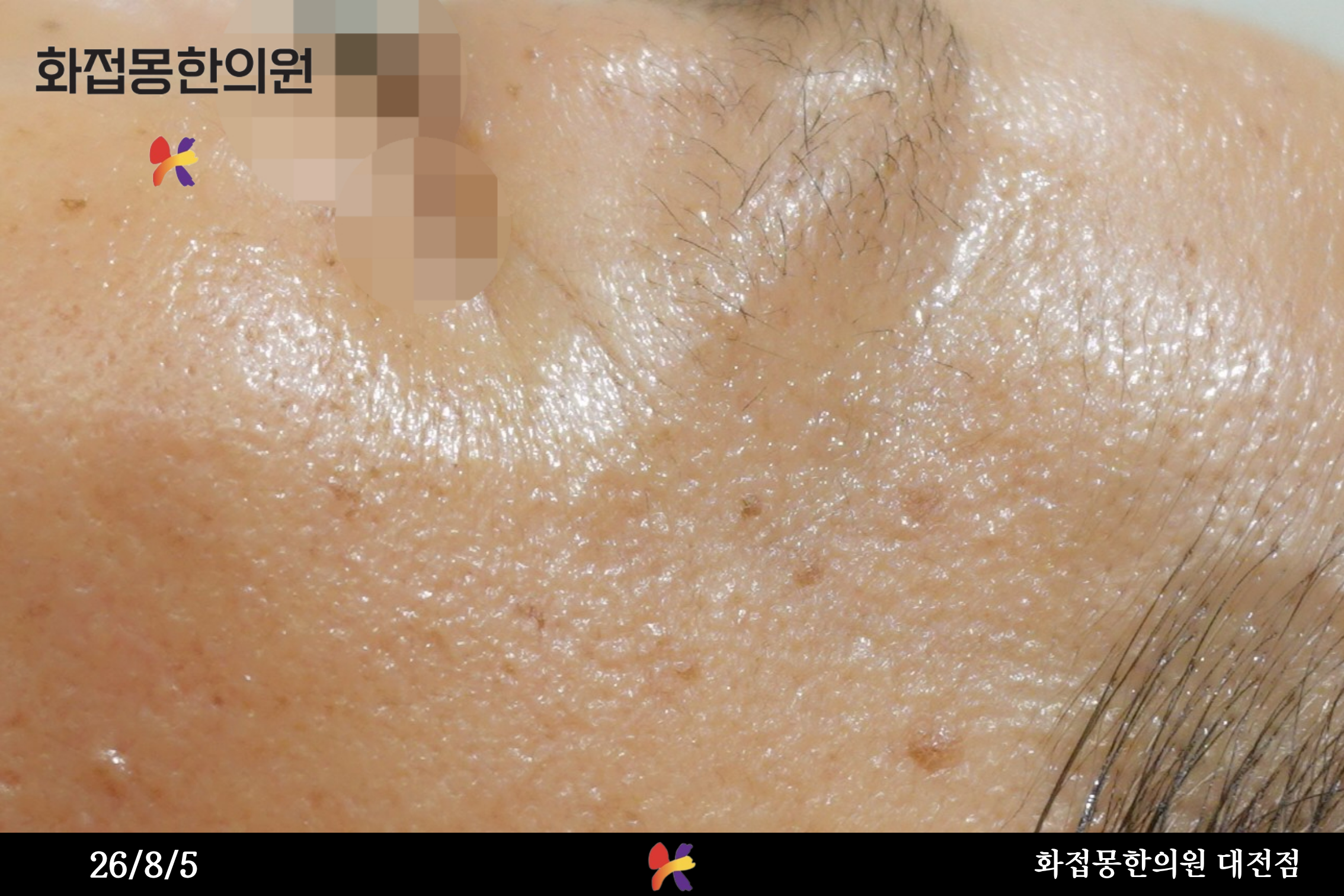 전후사진