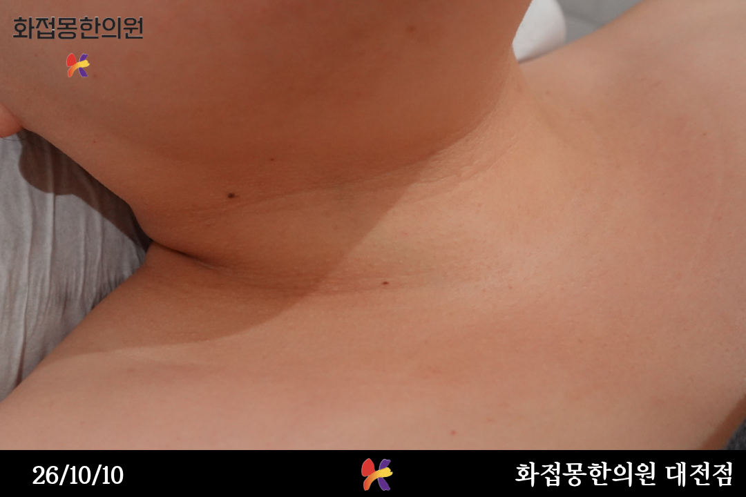 전후사진