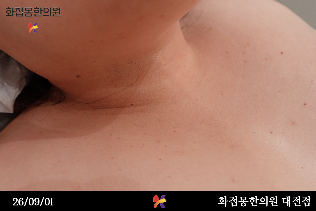 전후사진