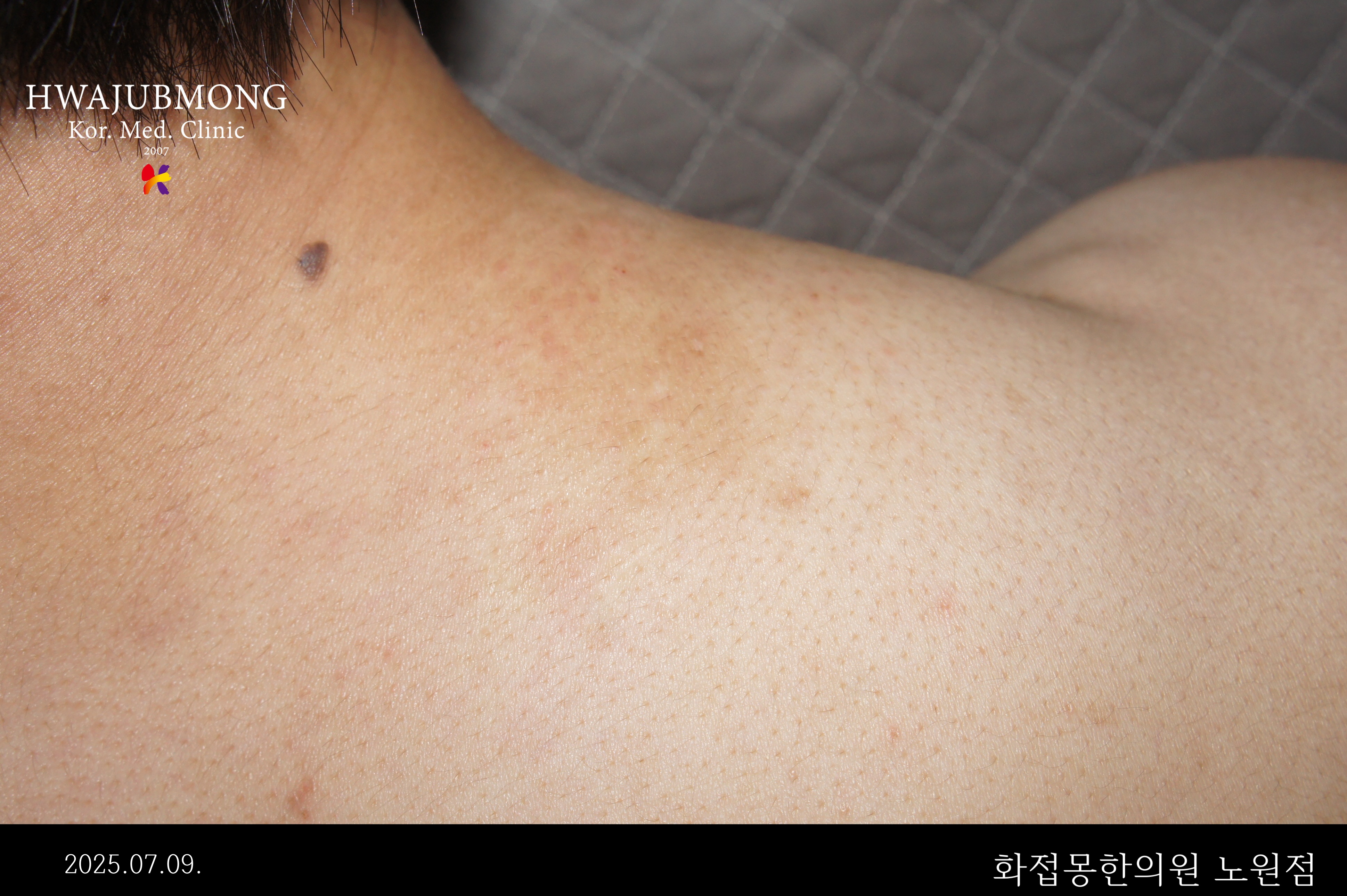 전후사진