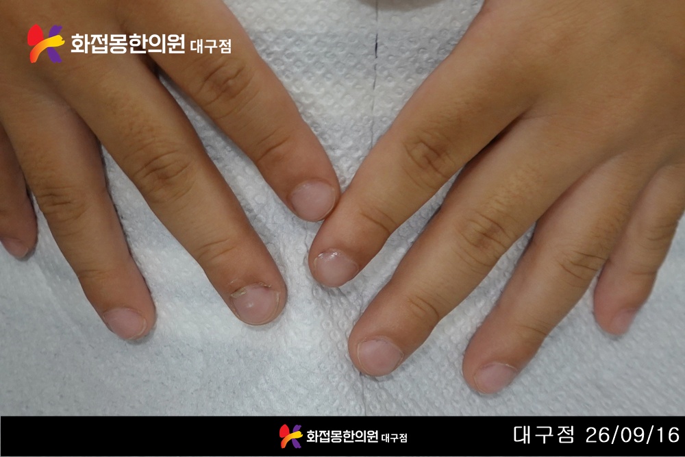 전후사진