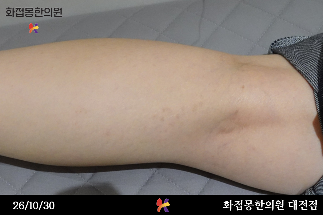 전후사진