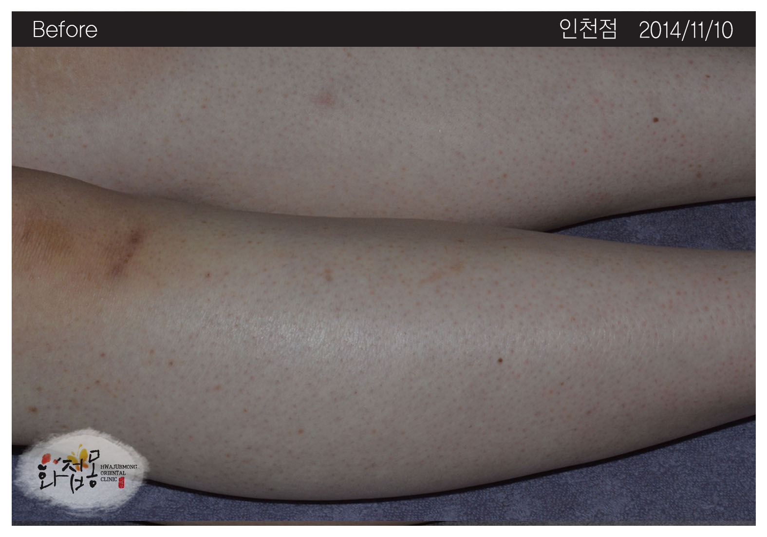 전후사진