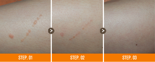 화접몽한의원 편평사마귀 전후사진