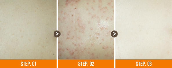 화접몽한의원 편평사마귀 전후사진