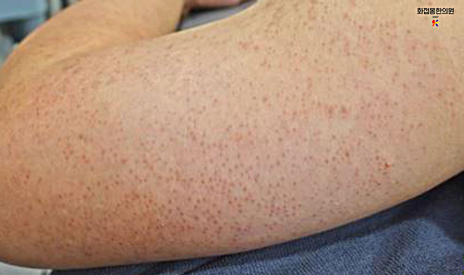 시술 전 사진