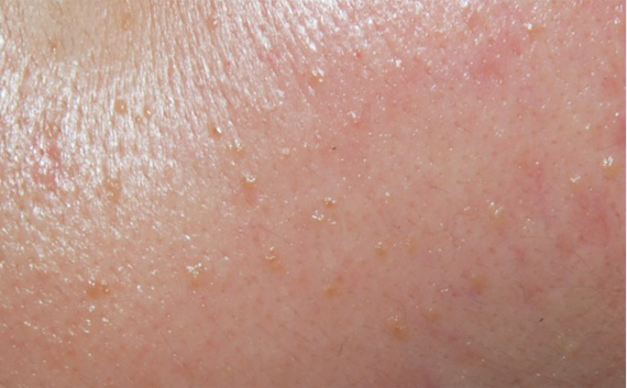 비 활동성 사마귀