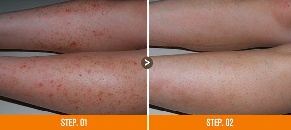 화접몽한의원 모공각화증 전후사진