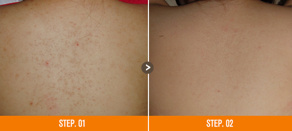 화접몽한의원 모공각화증 전후사진