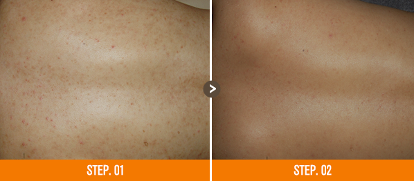 화접몽한의원 모공각화증 전후사진