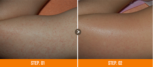 화접몽한의원 모공각화증 전후사진